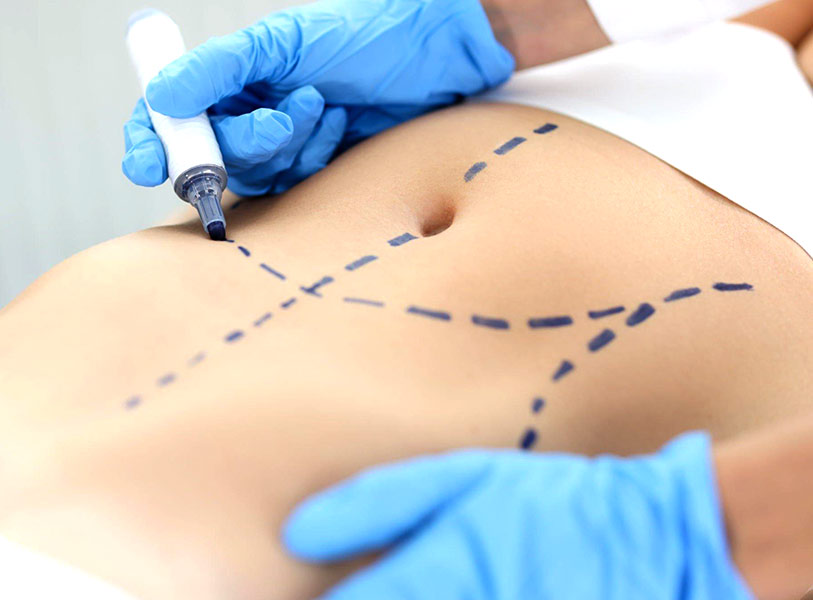 abdominoplasty in indore, plastic surgeon indore