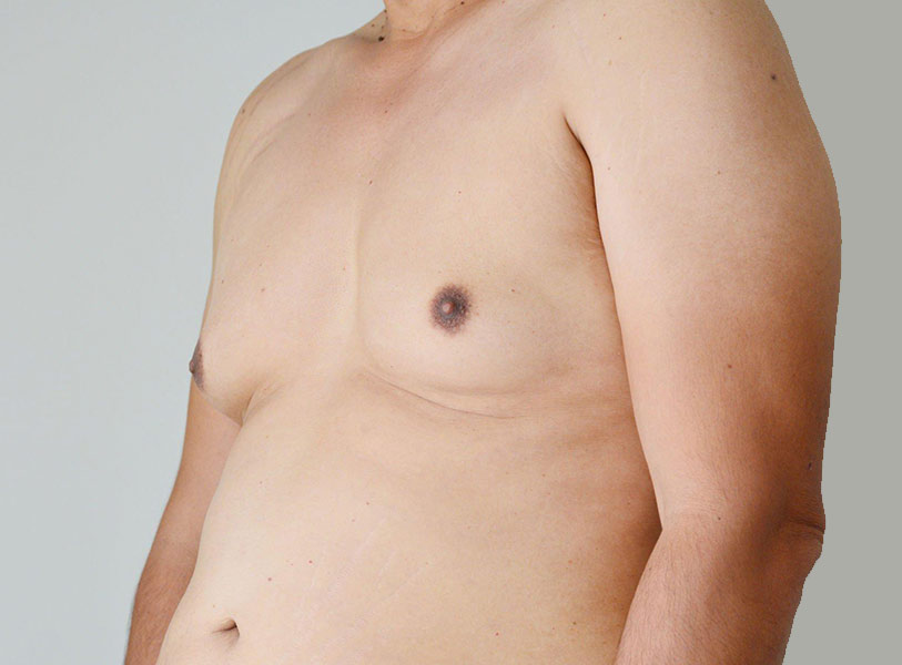 gynecomastia treatment in indore, gynecomastia doctor in indore