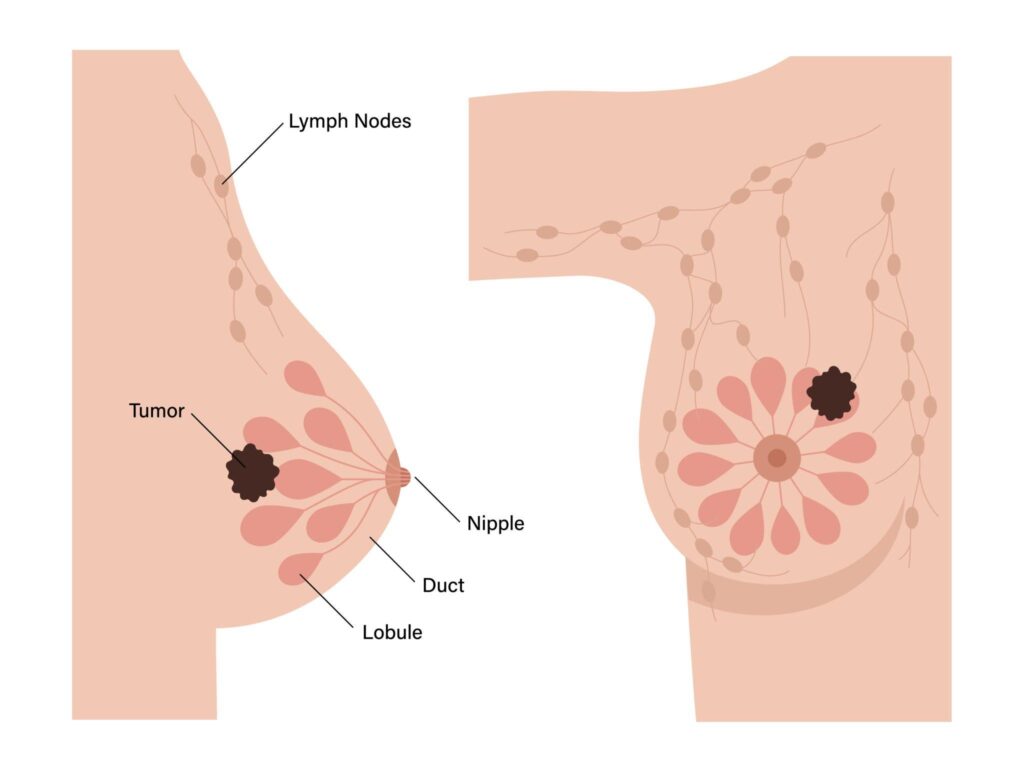 breast doctor in indore, best breast doctor in indore