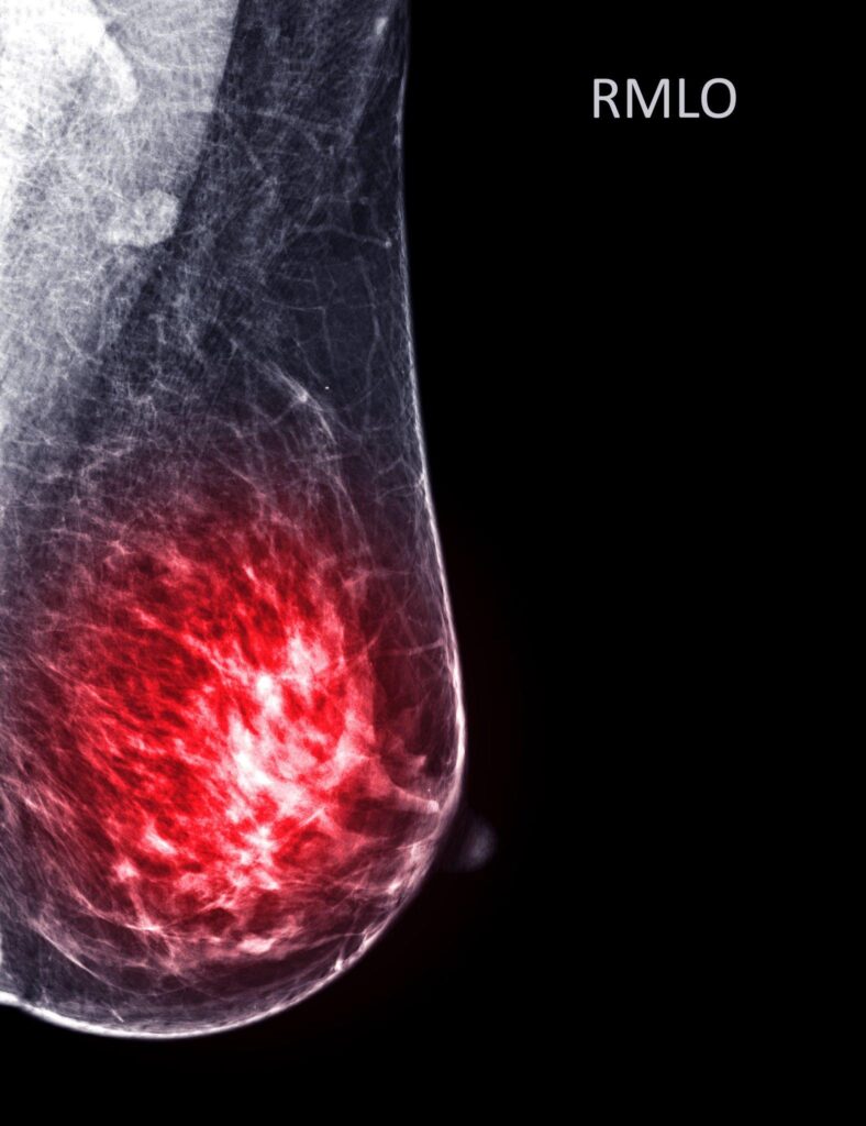 breast excision surgery in indore, breast doctor in indore