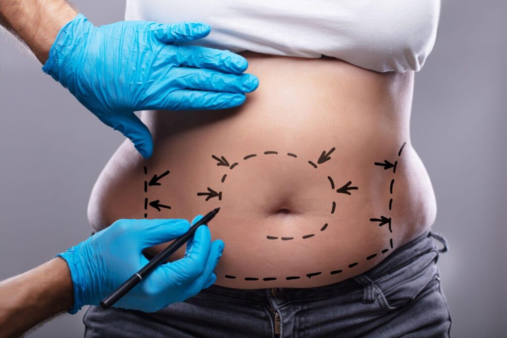 liposuction in indore, liposuction dr in indore