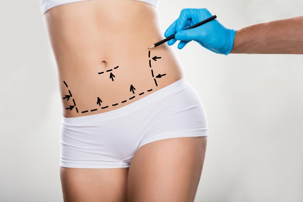 liposuction in indore, liposuction dr in indore, best liposuction surgeon in indore