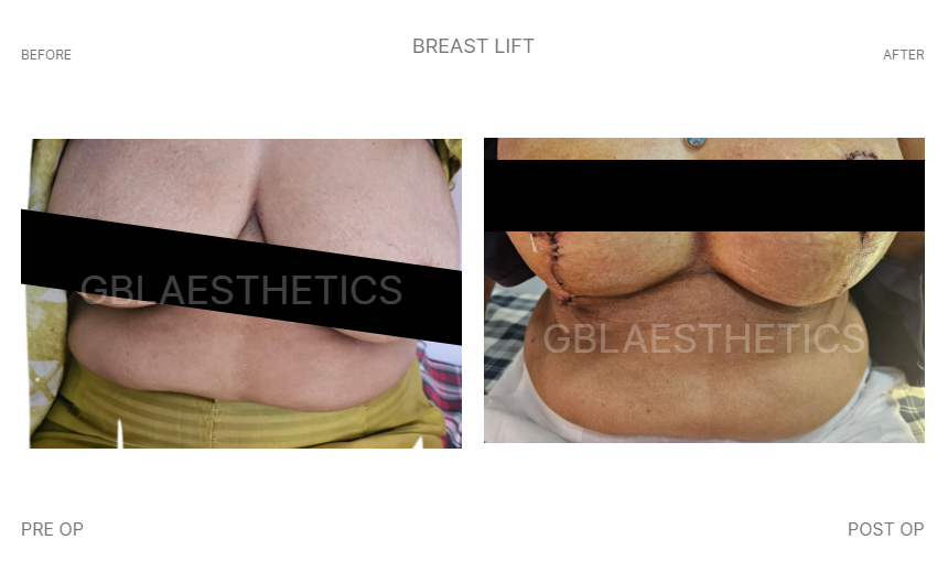 breast doctor in indore, breast lift doctor in indore