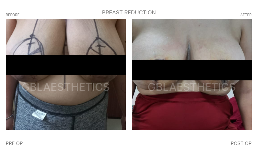 breast doctor in indore, breast aesthetics in indore