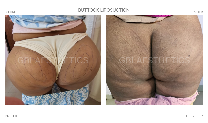 liposuction in indore, liposuction doctor in indore
