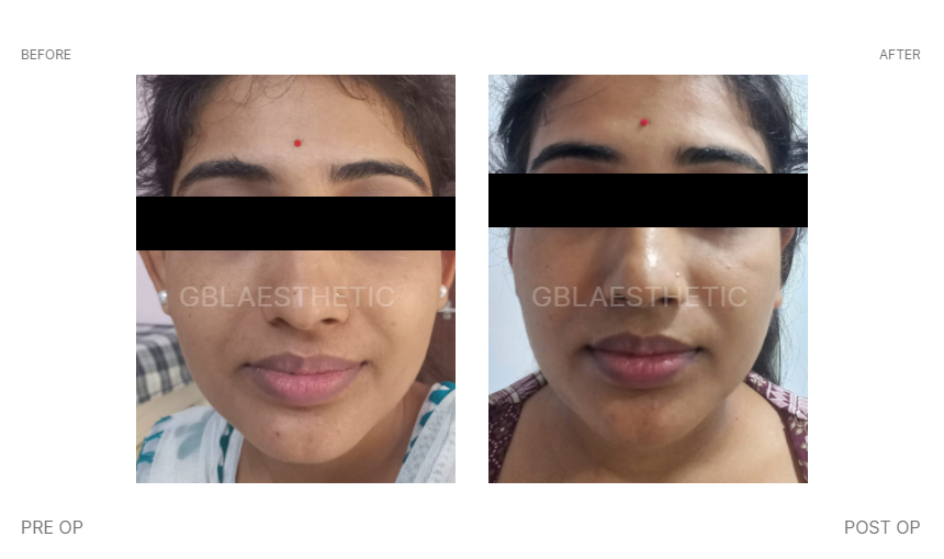 Bat ear surgery treatment in Indore, Prominent ear treatment in indore