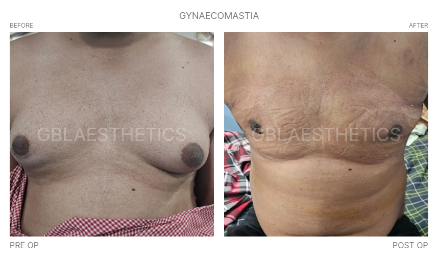 gynecomastia doctor in indore, gynecomastia treatment in indore