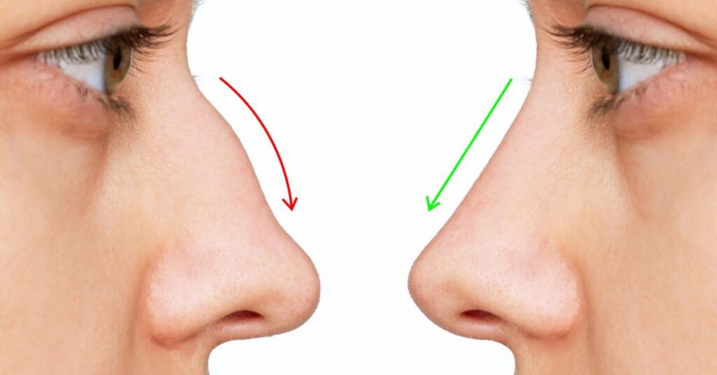 Rhinoplasty in Indore, best Rhinoplasty in Indore, Rhinoplasty surgery in Indore