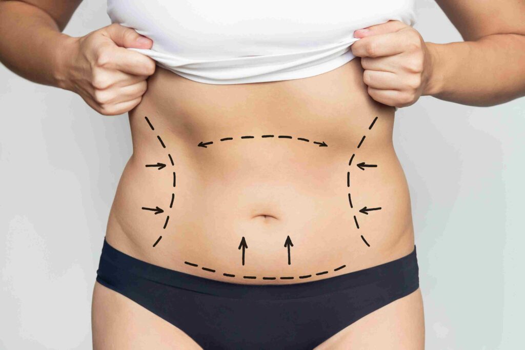 liposuction doctor in indore liposuction in indore best liposuction surgeon in indore liposuction doctor in indore best liposuction surgeon in indore