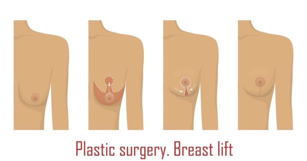 breast lift surgery in indore, best breast lift surgery in indore, breast doctor in indore, breast aesthetics in indore, breast lift doctor in indore, breast plastic surgeon in indore, breast plastic surgery in indore, breast reconstruction surgeons in indore